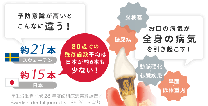 お口の病気が全身の病気を引き起こす(脳梗塞・糖尿病・動脈硬化・心臓疾患・早産・低体重児)予防意識が高いとこんなに違う(スウェーデン約21本、日本約15本・・・80歳での残存歯数平均は日本が約6本も少ない)